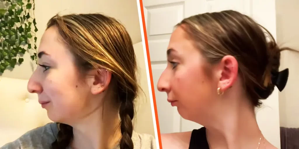 ‘OMG’: This Girl Undergoes Jaw Surgery and Amazed the Internet With Before-and-After Photos