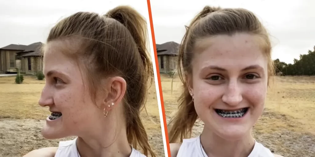 This Girl Underwent Double Jaw Surgery — Before-and-After Photos Left Everyone Speechless