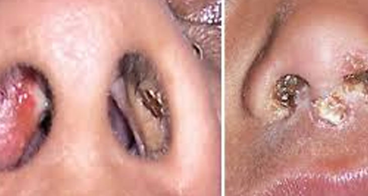 4.. Why You Keep Getting Pimples Inside Your Nose, and What to Do About it